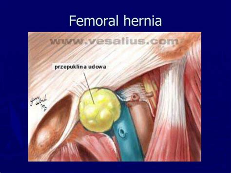 what is a femoral hernia.